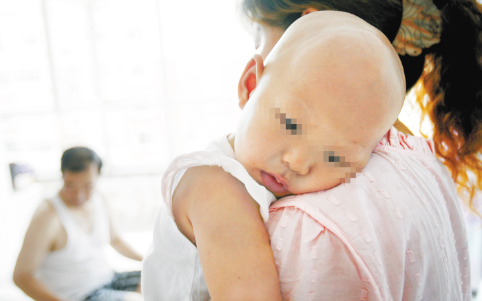 一岁女娃先天性外胚胎发育不良<em>头发眉毛</em>都<em>掉</em>光