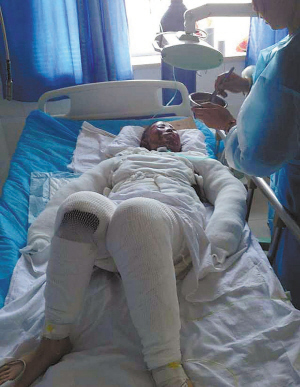 老乡 好心人 医院联手救治烧伤女孩